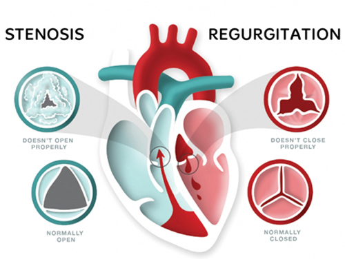 Ayurvedic Treatment For Heart Valve Stenosis Ayurvedic Treatment For Heart Valve Stenosis